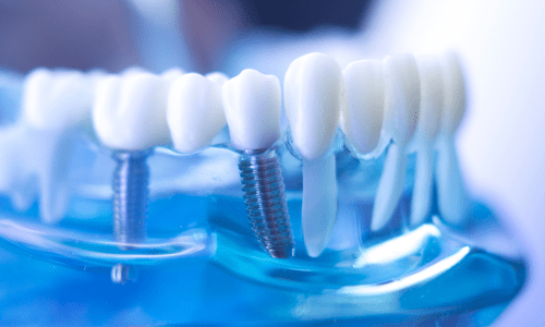 Cấy ghép răng Implant cần lưu ý những gì ?